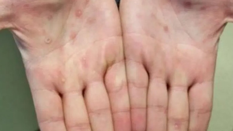 Monkeypox patient disappears after locking his home in Mardan: DC