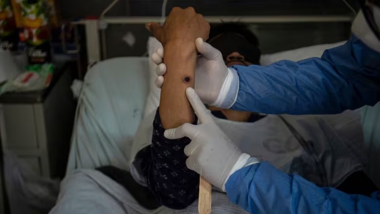 Fourth case of mpox reported in Pakistan this year