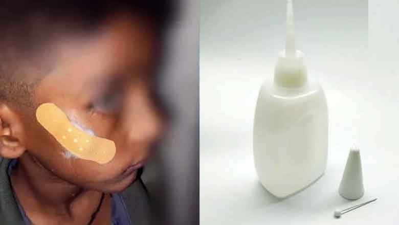 India: Govt nurse uses superglue to close child's wound instead of stitches