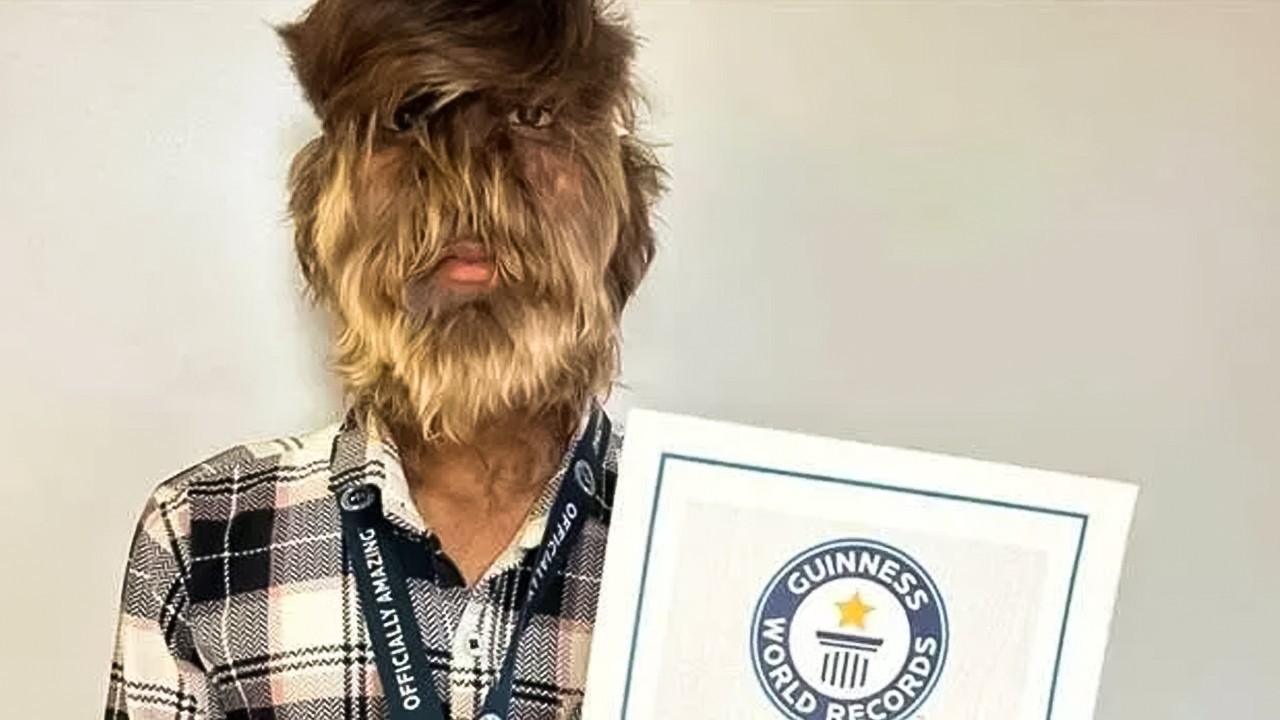 "One in a billion:" Teen with 95% of his face covered in hair sets Guinness World Record