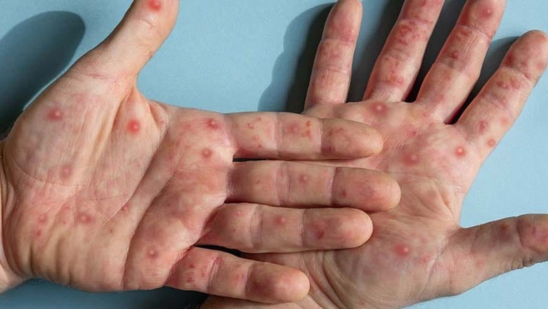 First confirmed case of mpox reported in Karachi