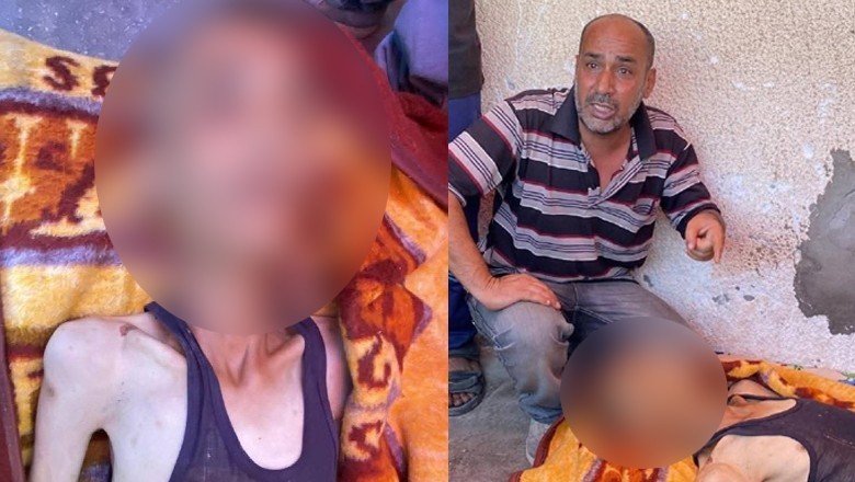 Palestinian with diabetes die of malnutrition as hunger crisis deepens