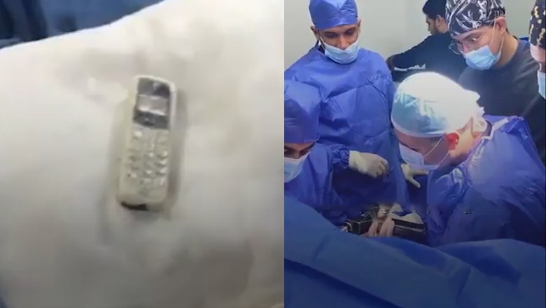 Man swallows mobile phone, undergoes successful surgery