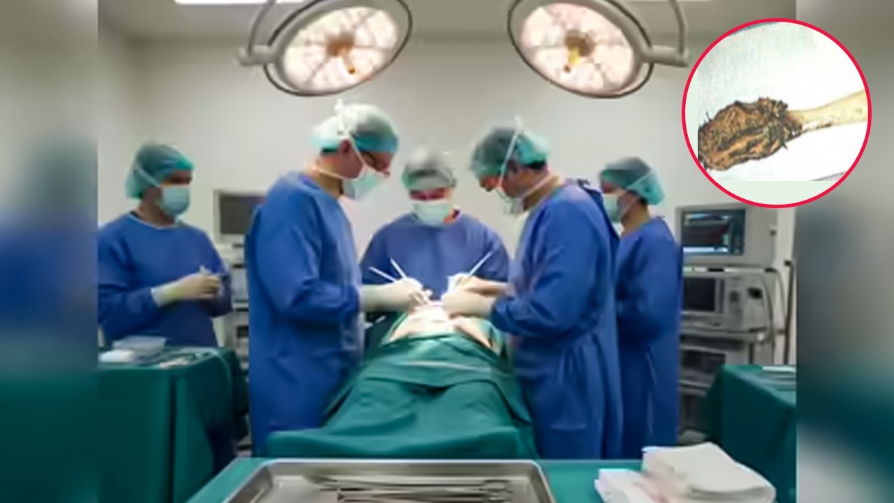 Punjab doctors remove toothbrush from man’s stomach