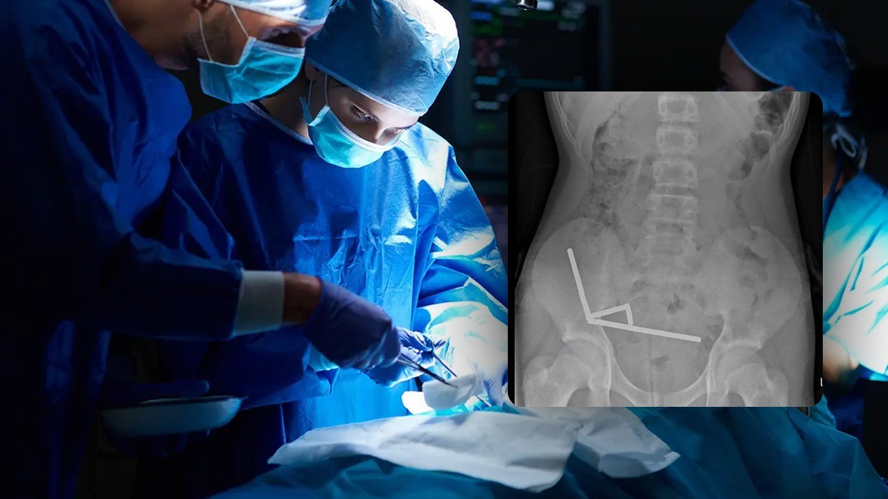 Teenager swallows 100 Temu magnets in New Zealand, undergoes surgery